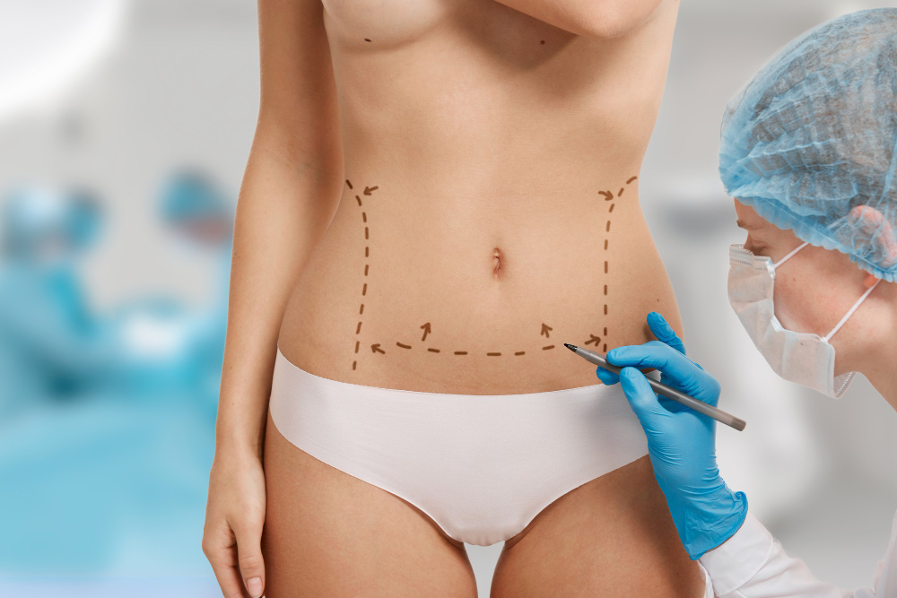 Tummy Tuck Surgery